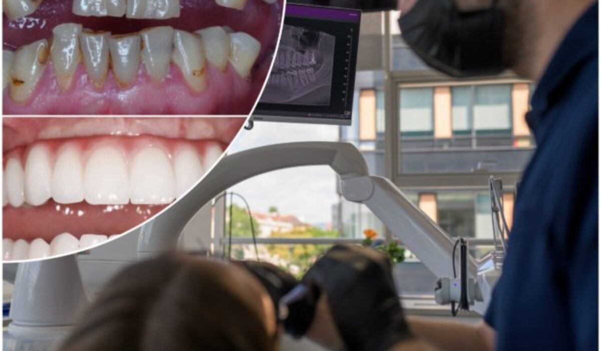 Zubné implantáty zmenia život, prinavrátia sebavedomie a najmä zdravie