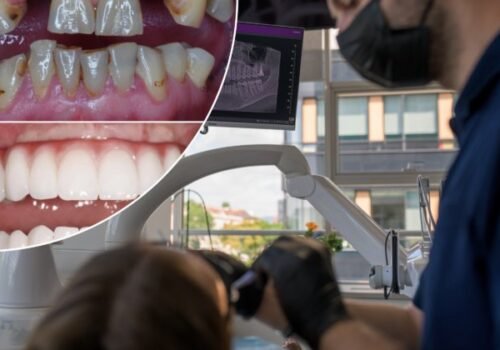 Zubné implantáty zmenia život, prinavrátia sebavedomie a najmä zdravie